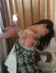 明星有拔罐的,拔罐疗法助力健康美